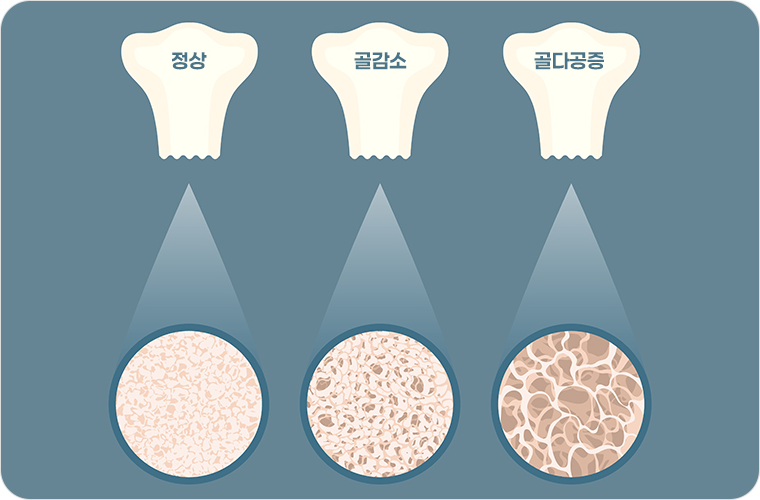 황색인대 골화증 이미지