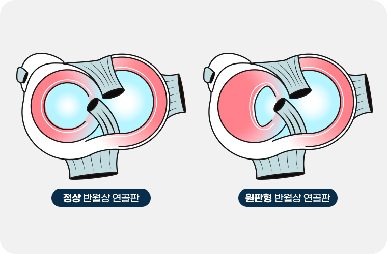 척수증 이미지