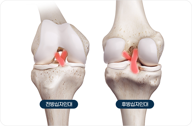 척수증 이미지